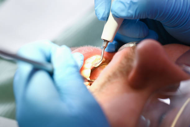 Best Emergency Root Canal Treatment in Gold Key Lake, PA